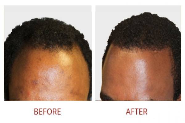 smp before after left