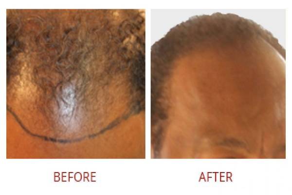 smp before after right