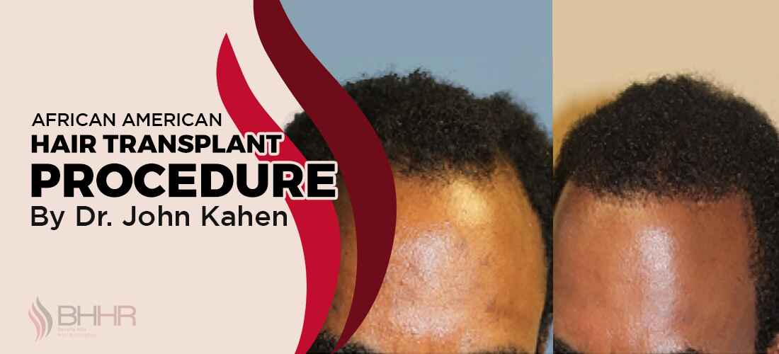 African American Hair Transplant 
