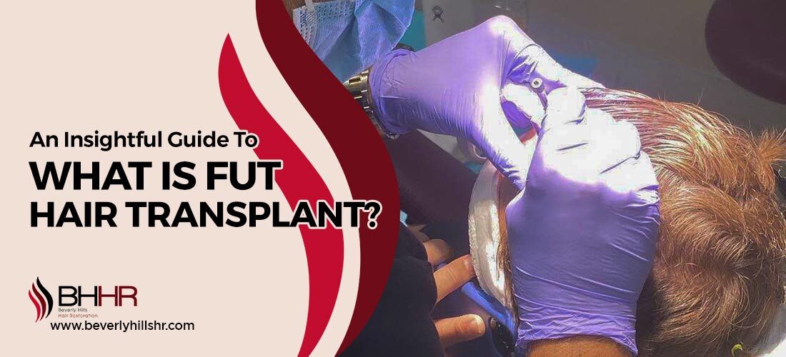 What Is FUT Hair Transplant