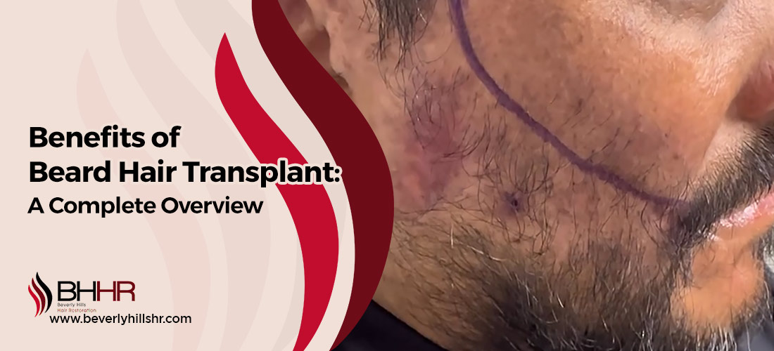 Benefits of Beard hair transplant