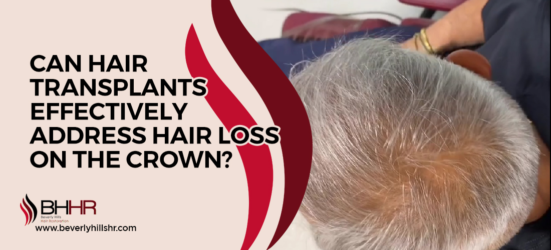 Crown hair transplant