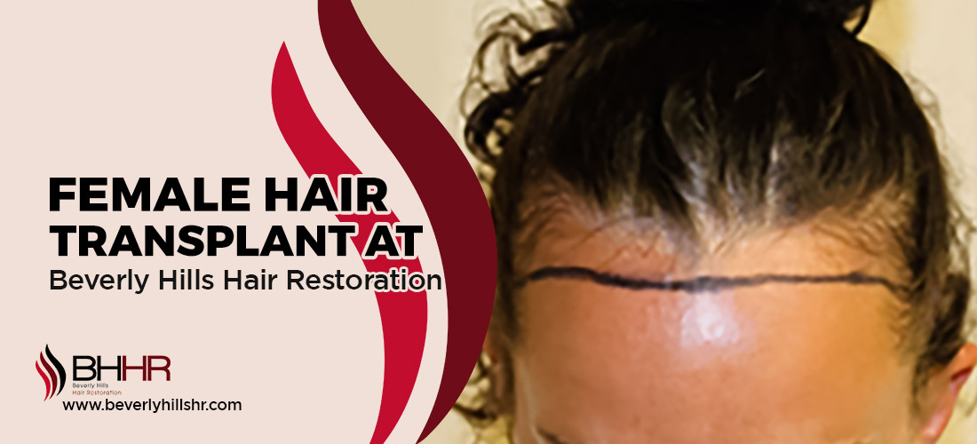 Hair Transplant For Women
