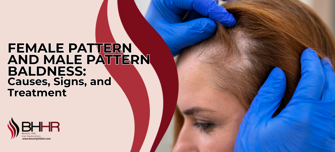 Female Pattern and Male Pattern Baldness