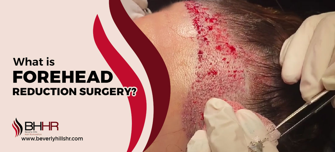 What is forehead reduction surgery