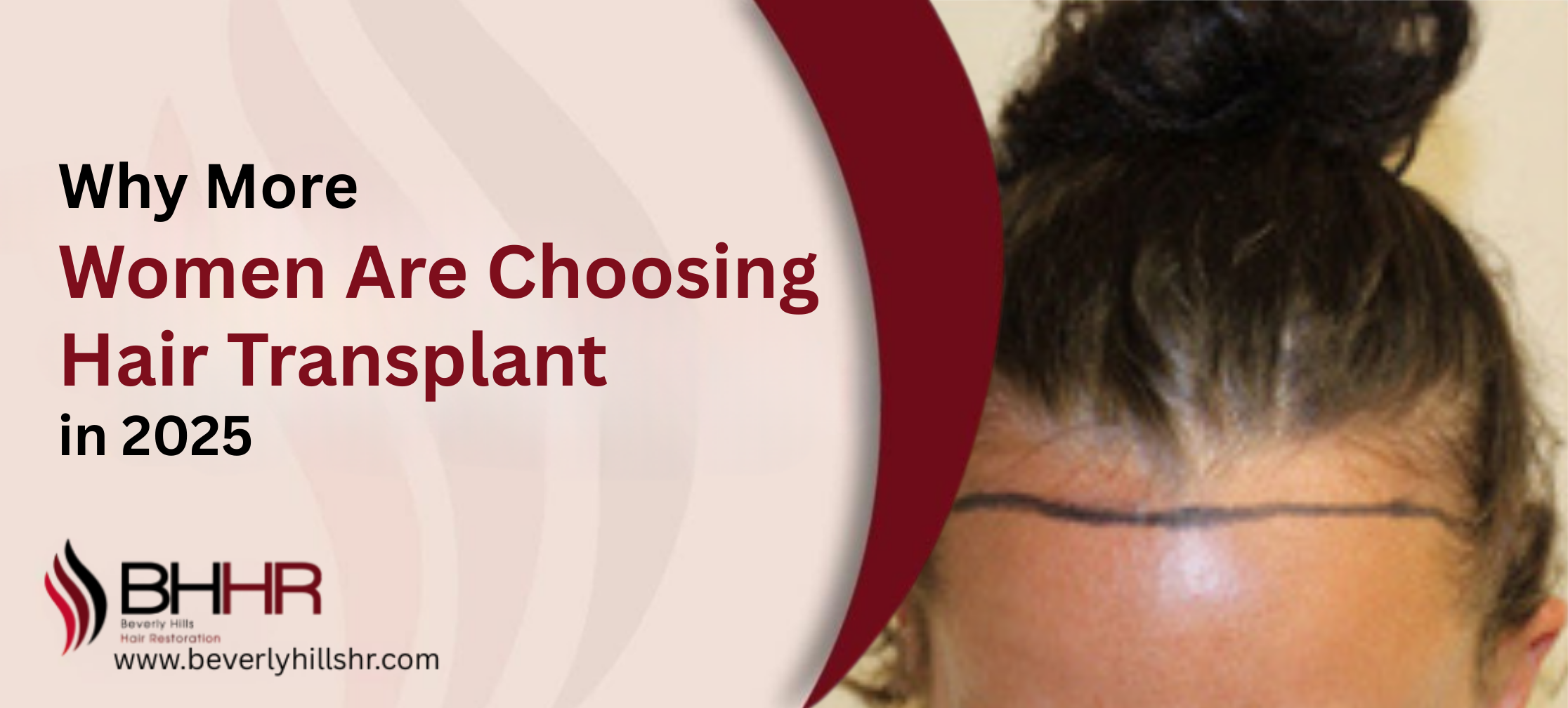 Hair Transplant For Women