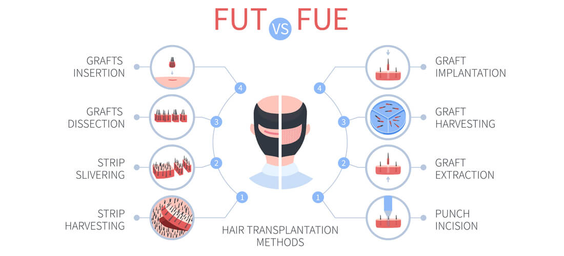 Fue Vs Fut Hair Transplant: Which Is Better For You?
