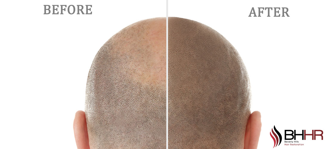 Scalp MicroPigmentation Cost