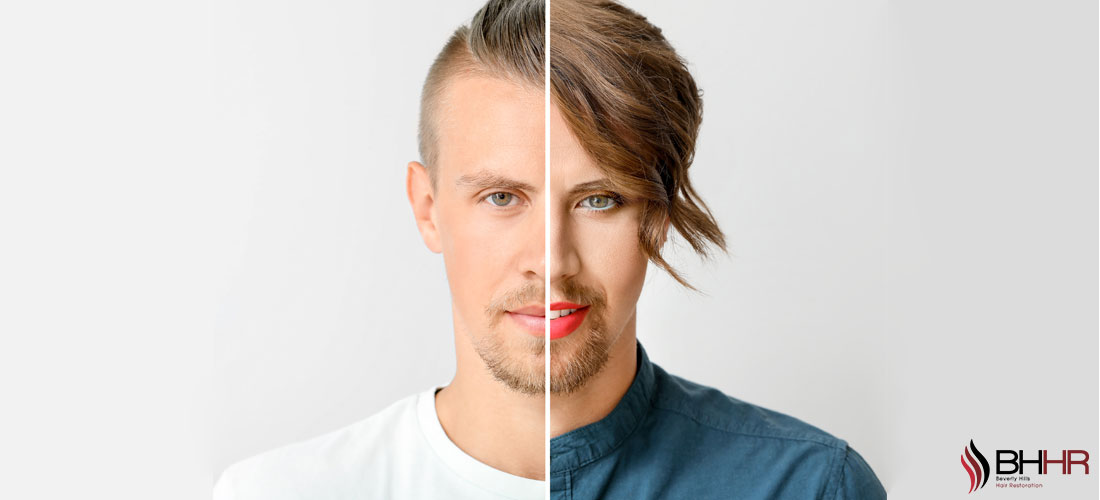 transgender hair transplant