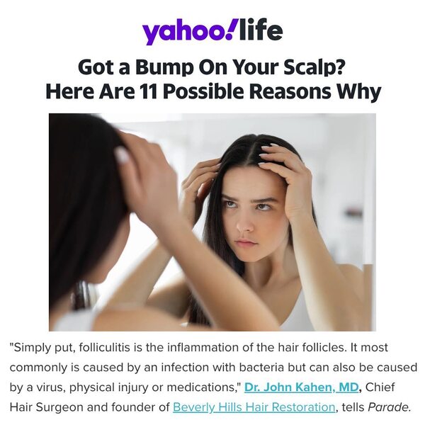 buzzfeed news hair transplant los angeles bhhr