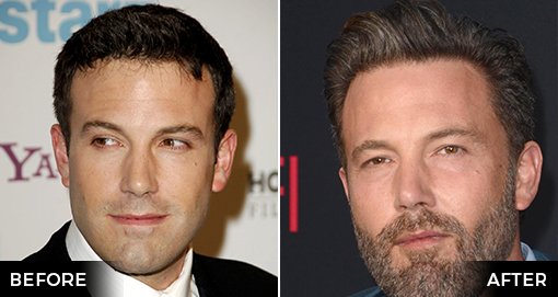 BEN AFFLECK HAIR TRANSPLANT