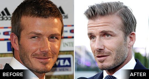 DAVID BECKHAM HAIR TRANSPLANT