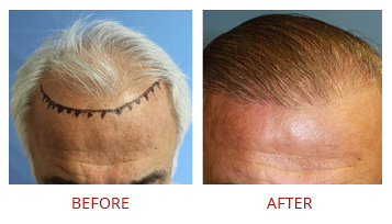 FUE Hair Transplant Before After