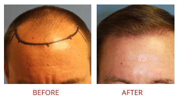 FUE Hair Transplant Before After 1