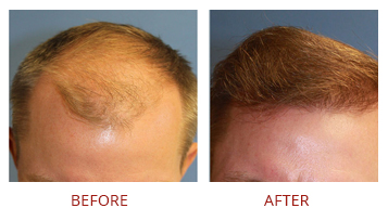 FUE Hair Transplant Before After 2