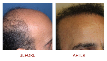 FUT hair transplant result