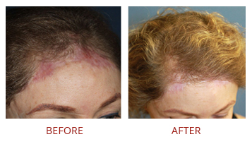 FUE Hair Transplant Before After 5