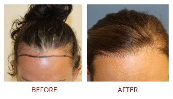 Hair Transplant Solutions