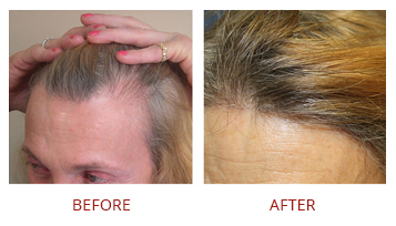 Hair Transplant Solutions