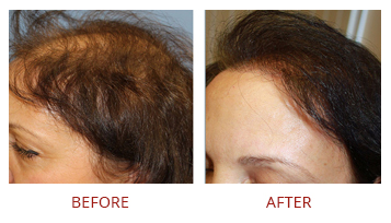 facial-hair-restoration