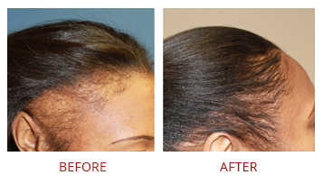 FUT hair transplant before and after result