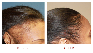 Hair Transplant Solutions