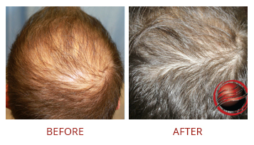 platelet-rich-plasma-prp-hair-restoration
