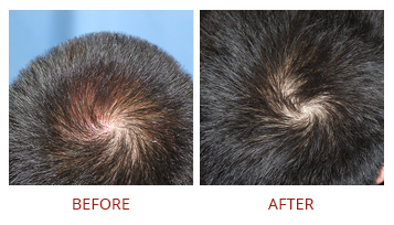 platelet-rich-plasma-prp-hair-restoration