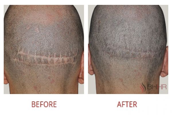 scalp-micropigmentation